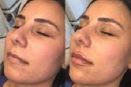 حقن البوتوكس في أبو ظبي