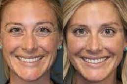 حقن البوتوكس في رأس الخيمة