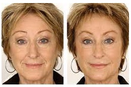 حقن الحشوات الجلدية في دبي وأبو ظبي