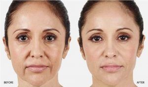 حقن الحشوات الجلدية في دبي والشارقة