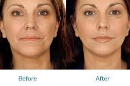 حقن الحشوات الجلدية في وأبو ظبي والشارقة