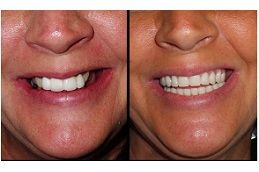 زراعة الأسنان دبي وأبو ظبي