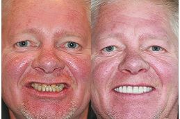 زراعة الأسنان في دبي وأبو ظبي