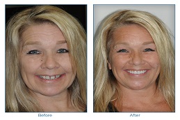 زراعة الاسنان في ابوظبي