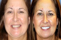 زراعة الاسنان في الامارات