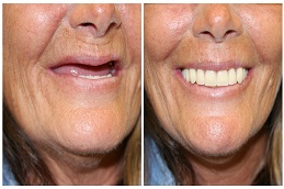 زراعة الاسنان في دبي والشارقة