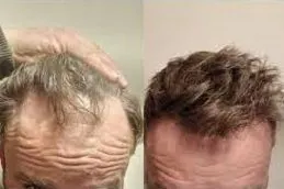 زراعة الشعر في دبي