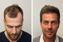 زراعة الشعر