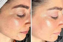 شد الوجه بالهيدرافيشل