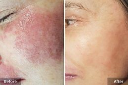 علاج إزالة الوحمات بالقرب مني