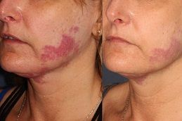 علاج إزالة الوحمات في دبي