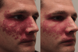 علاج إزالة الوحمات