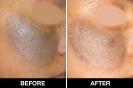 علاج الوحمات