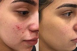 علاج حب الشباب بالليزر