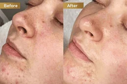 علاج حب الشباب بالهيدرافيشل