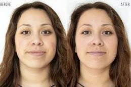 فوائد الهيدرافيشل للوجه