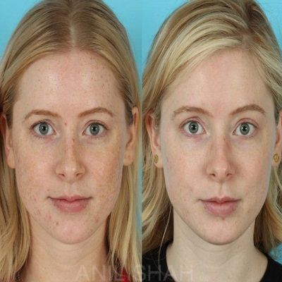 علاج إزالة الوحمات