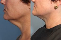 شفط دهون الذقن قبل وبعد: