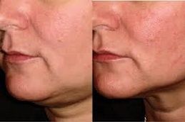 شفط دهون الذقن في دبي وأبو ظبي والشارقة تكلفة شفط دهون الذقن