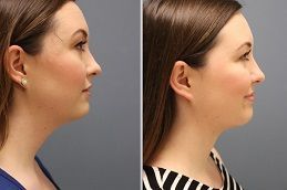 شفط دهون الذقن في دبي وأبو ظبي والشارقة تكلفة شفط دهون الذقن