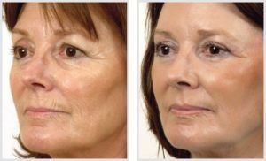 علاجات العناية بالبشرة بالليزر