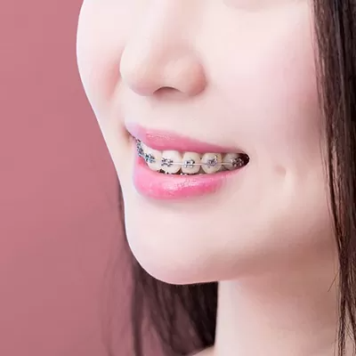 الأجهزة الثابتة للأسنان في دبي و أبو ظبي