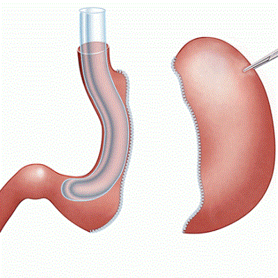المعدة جراحة عالية الخطورة في دبي