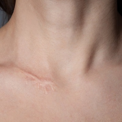 جراحة مراجعة الندبة في دبي و ابو ظبي والشارقة | ندبة الجراحية التكلفة