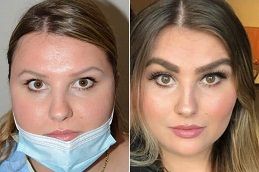 زراعة الحواجب في أبوظبي