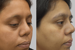 زراعة الحواجب في الإمارات العربية المتحدة