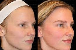 زراعة الحواجب في الشارقة