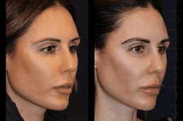 زراعة الحواجب في العين