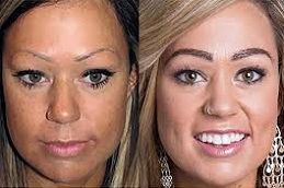 زراعة الحواجب في دبي