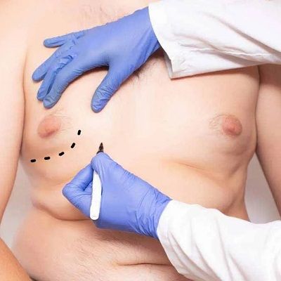 علاج التثدي في دبي للرجال أسعار ونتائج دائمة