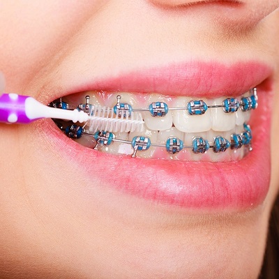 علاج تقويم الأسنان المبكر في دبي وأبو ظبي تكلفة تقويم الأسنان المبكرة