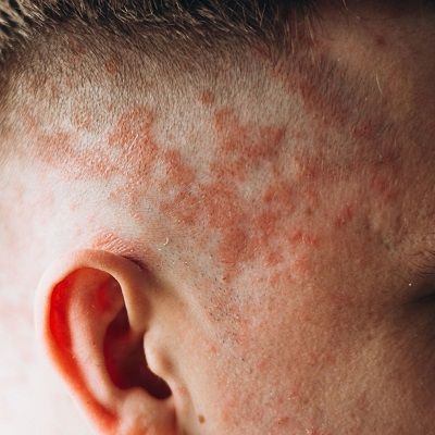 هل يمكن لطبيب الأمراض الجلدية علاج أكزيما فروة الرأس في دبي