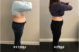 حقن مونجارو