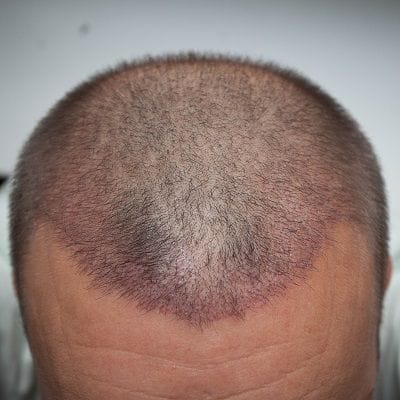 كيف تبدو عملية زراعة 2000 بصيلة شعر؟